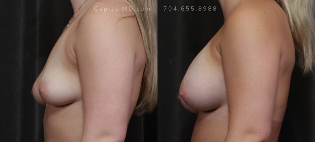 Breast Augmentation