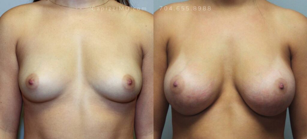 Breast Augmentation Gallery