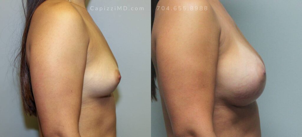 Breast Augmentation