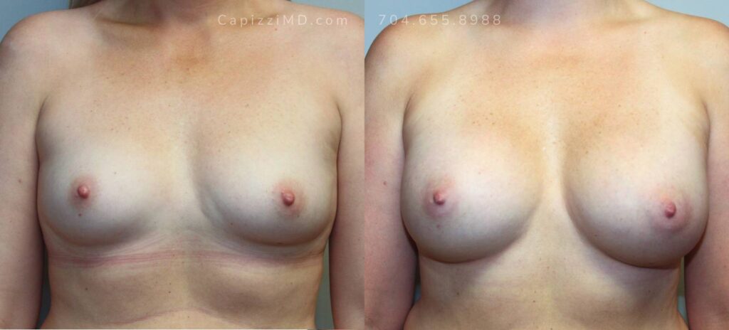Breast Augmentation