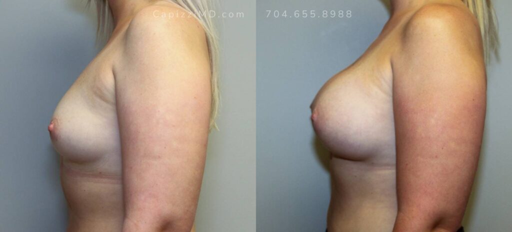 Breast Augmentation