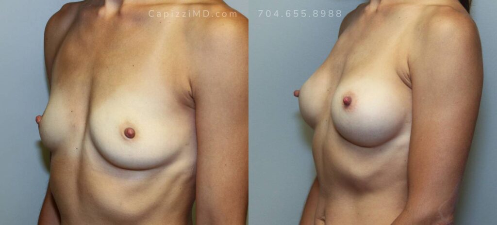 Breast Augmentation Gallery