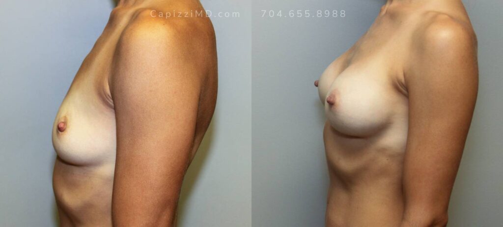 Breast Augmentation Gallery