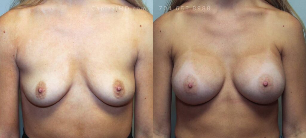 Breast Augmentation Gallery