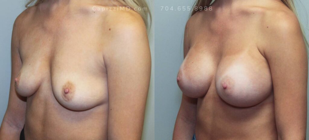 Breast Augmentation