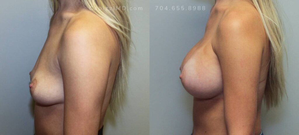 Breast Augmentation