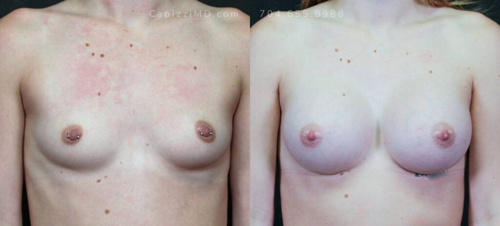 Breast Augmentation