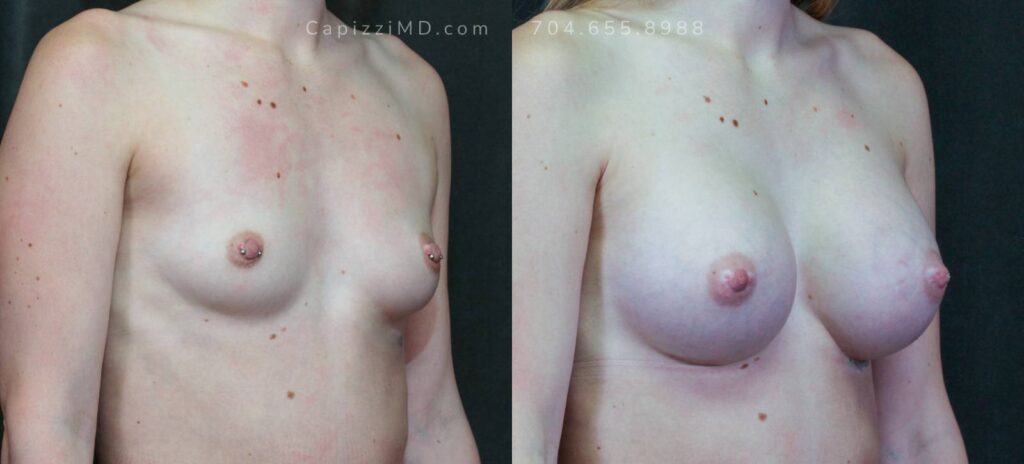 Breast Augmentation