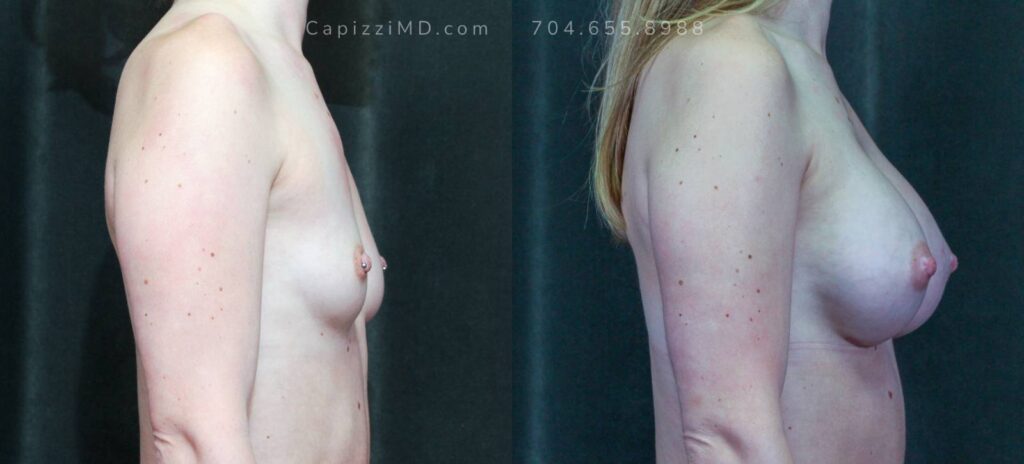 Breast Augmentation Gallery