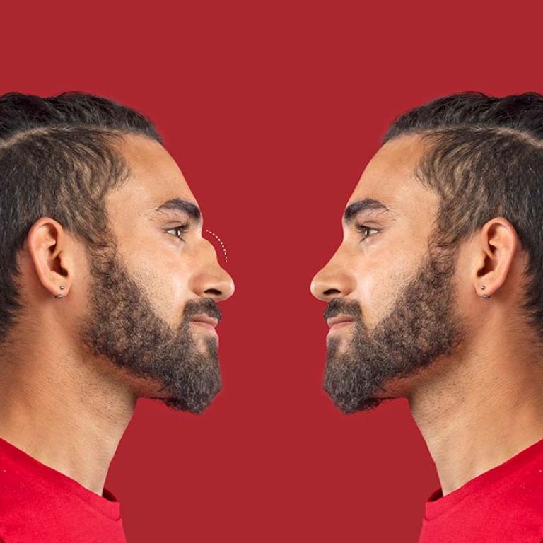 Before and After Comparison of a Man with an Ultrasonic Rhinoplasty