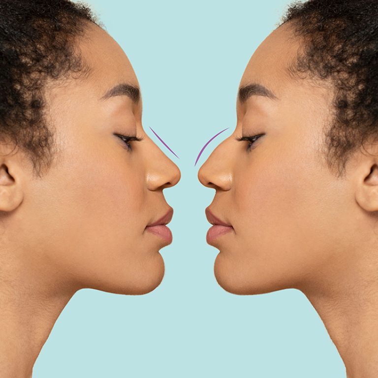 Before and After a Nose Job (Liquid Rhinoplasty) Mirror Image.