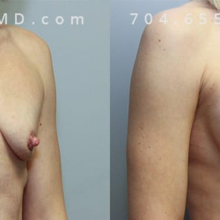 Breast Aug + Full Lift Sientra Textured Shaped Round Base High Projection 370cc. 1-year post-op. Oblique view.