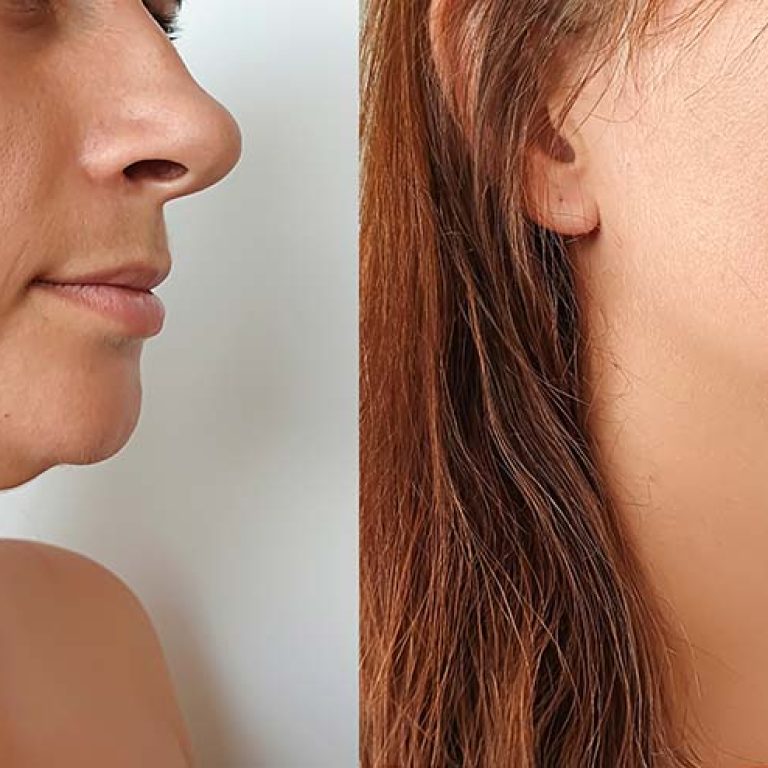 How Can I Get Rid of My Double Chin?