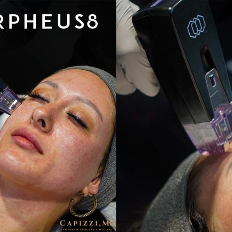 Is Radiofrequency RF Microneedling the Secret to Tighter-Skin?