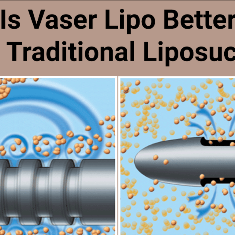 Vaser Lipo breaking up fat cells with ultrasound and traditional Liposuction tip sucking up fat cells.