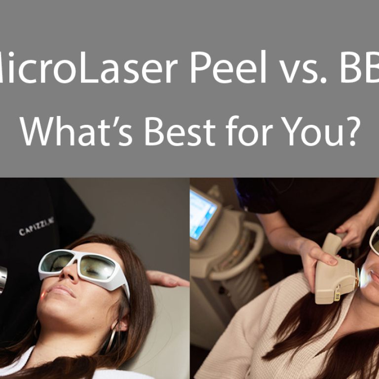 Images of women getting MicroLaser Peel and Broad Band Laser Treatments with the words :MicroLaser Peel vs. BBL What is best for you?