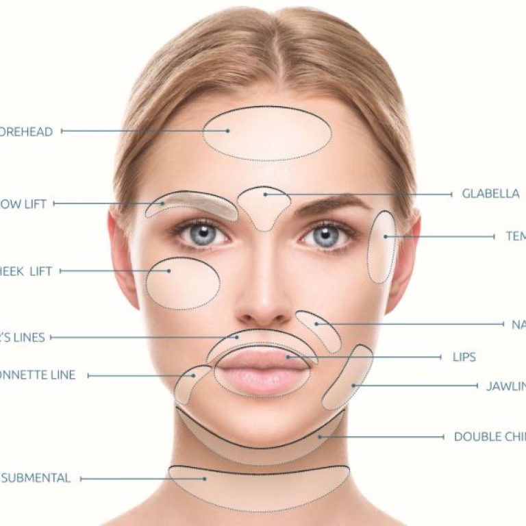 Woman's face marked for areas that can be helped using PDO Thread Lifts.