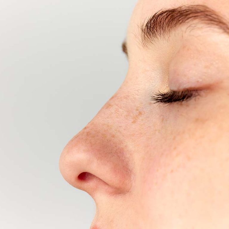 Woman's nose after a Septoplasty. Septoplasty vs. Rhinoplasty